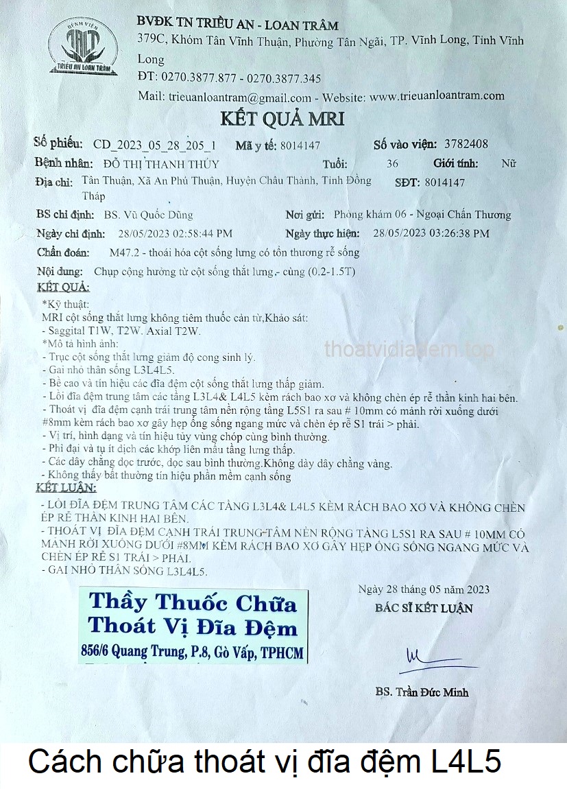 Cách chữa thoát vị đĩa đệm L4L5